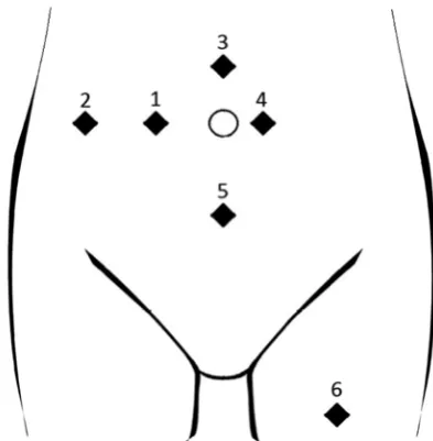 Fig. 1. Electrode placement over the abdominal wall