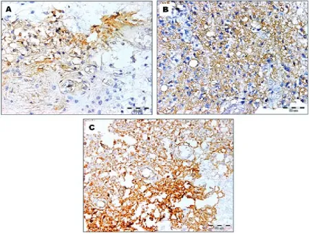 Table 1. CD44v6 and E-cadherin expression in gliomas