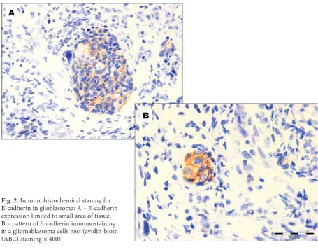 Fig. 3. Simultaneous CD44v6/E-cadherin expression in gliomas. Significant differences between immino-phenotyp E-cadherin +/CD446- and E-cadherin +/CD44v6+ were found (p = 0.004)