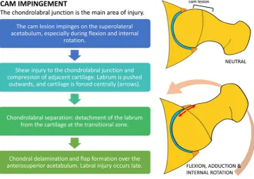 Fig. 1 Diagram outlining themechanisms of chondral andlabral injury in cam impingement.The main focus of injury is thechondrolabral junction