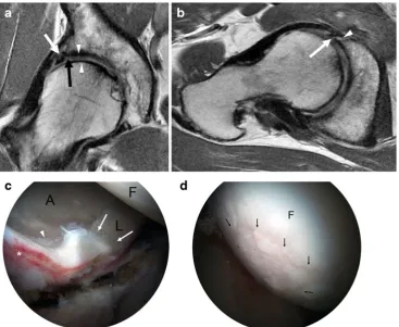 Fig. 9 A 36-year-old man with cam-type FAI and severe osteoarthritis.demonstrate chronic degeneration of the labrum (Coronal (a) and sagittal (b) PD-weighted MR images of the right hiparrowhead)