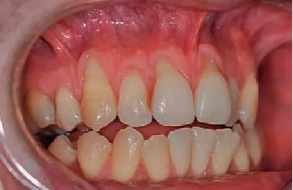 Fig. 2. Morphological Miller’s classification of gingival recessions in four different classes [6]