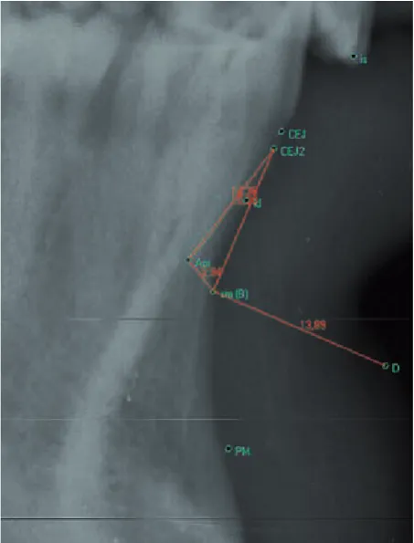 Fig. 7. Measurement on lateral X-rays in occlusion [7]