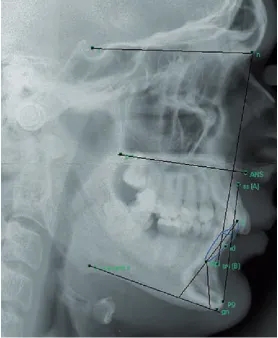 Fig. 8. Cephalomeric analyses of angle of bone labial width (CEJ2-B) and bone dehis-cence height (CEJ2-B) on lateral X-rays in occlusion [7]