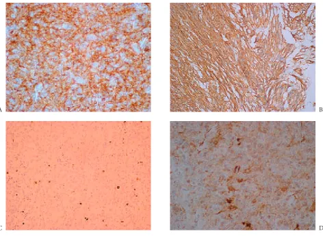 Fig. 1. A) CD117-positive GIST tumor with cytoplasmic staining, B) CD117-positive GIST tumor with membranous staining pattern, C) Ki-67 expression in 1% of cells, D) Positive CD34 expression