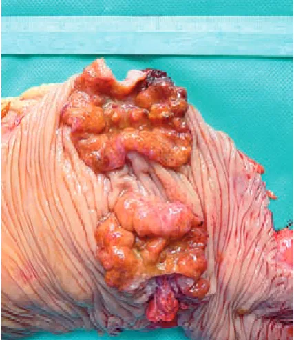 Table 2.Multifocal location of polyps was observed in 108 patients (22%). The most frequently, in 32 