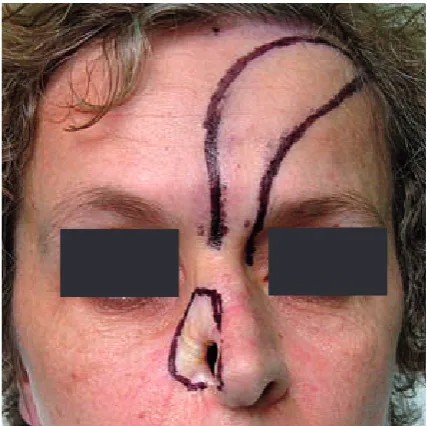Fig. 4. Nose after healing