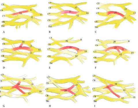 Fig. 8. an additional connection between anterior division of middle trunk (aDMT, 23) and medial root of median nerve (12) – red stars (figure courtesy of authors)