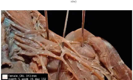 Fig. 10. Variant of the posterior division of the middle trunk (24) – connection with medial cord (18) – red star as well as extra connection between lateral cord (20) and medial root of median nerve (12) – green star (figure courtesy of authors)