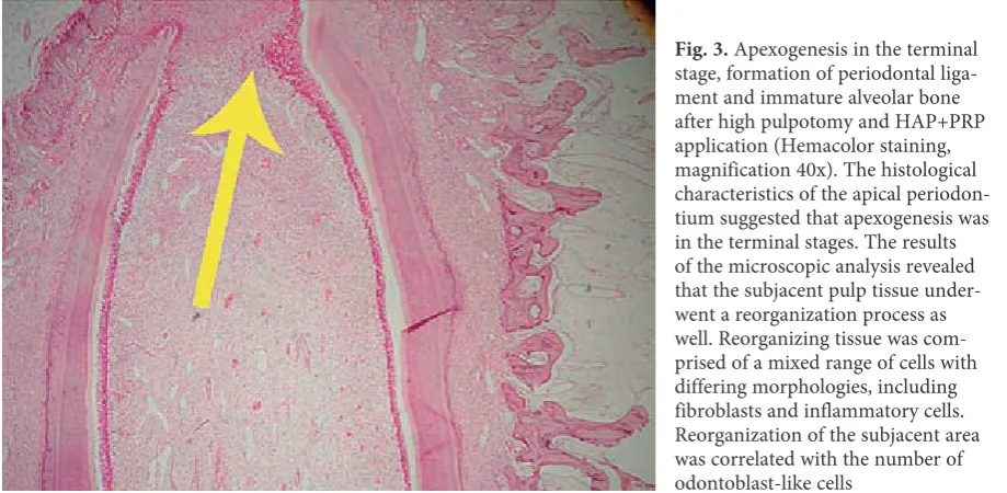 Fig. 2. Compact formation of dentin bridge after pulpotomy and HA + 