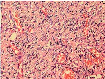 Fig. 1. The first week in the third group (high mag-nification ×400): exudative and necrotic layer at first week