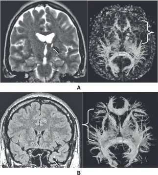 Fig. 1. Peculiarities of the tractographic pattern depending on brain lesion type:  А) a decrease in tract presen-tation (bracket) on the side of the lesion focus (arrow);  В) a decrease in tract presen-tation (bracket) on the side opposite to the lesion focus in a patient with a gliotic zone (arrow) in the medio-basal parts of the left tempo-ral lobe