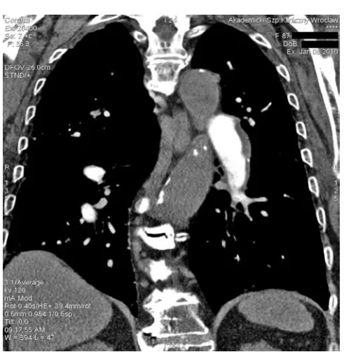 Fig. 3. Chronic phase of pulmonary embolism – the thrombo-embolic material with calcifications visible perimurally along the wall of the branch of the left pulmonary artery