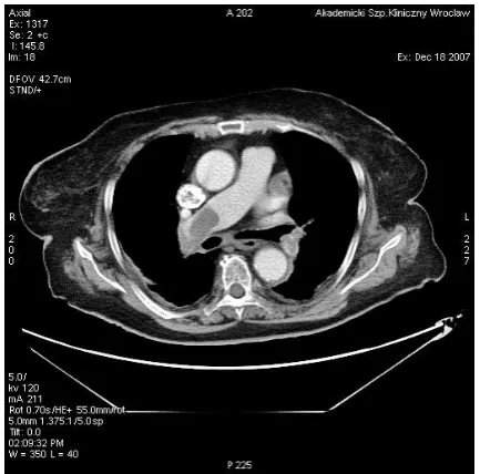 Fig. 4. The acute phase of pulmonary embolism com-plicated by right lung segmental infarction