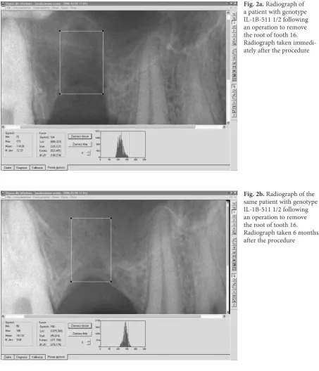 Fig. 2a. Radiograph of a patient with genotype 