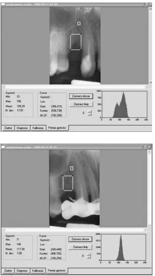 Fig. 3a. Radiograph of a patient with genotype IL-1B-511 2/2 fol-lowing an operation to remove the root of tooth 14