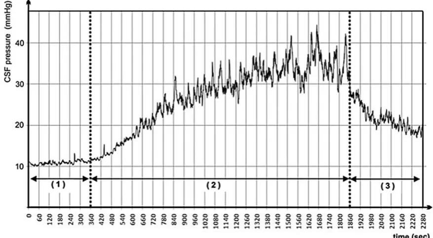 Fig. 1. Continuous recording of sample infusion test with marked investigated periods: 1 – stable, 2 – infusion, and 3 – decrease
