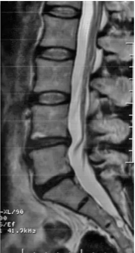 Fig. 2. MR, T2-weighted image, axial plane. Disc bulg-ing with high intensity zone (HIZ) in its posterior part, probably representing an annular tear