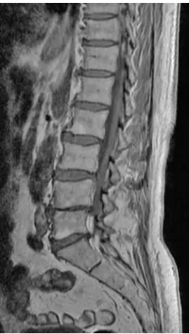 Fig. 6. MR, sagittal plane, T1-weighted image. There are multiple hyperintense areas in the l2–l5 vertebral bodies, adjacent to interverebral discs, which are con-sistent with Modic type 2 degenerative changes