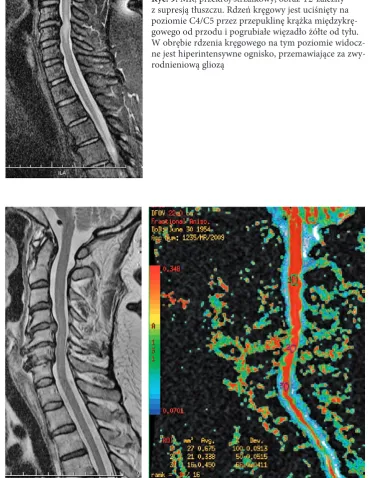 Fig. 9. MR, sagittal plane, T2-weighted fat suppressed the spinal cord at this level, which is consistent with image