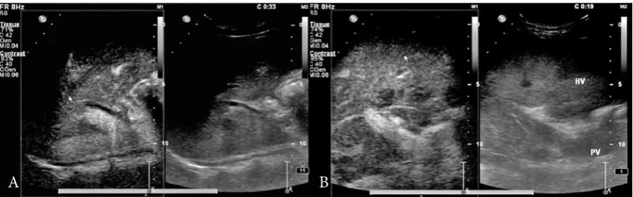 Fig. 1. A) Visualization of the hepatic artery after infusion of ultrasound contrast in healthy controls; B) visualization of the hepatic artery after infusion of ultrasound contrast in cirrhosis patients