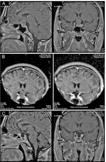 Fig. 1. A case of gross total resection of a Grade III pituitary macroadenoma. A) Preoperative high-field T1-weighted enhanced sagittal (left) and coronal (right) 1.15 T MRI scans showing a tumor compressing the optical chiasm and elevating the third ventr