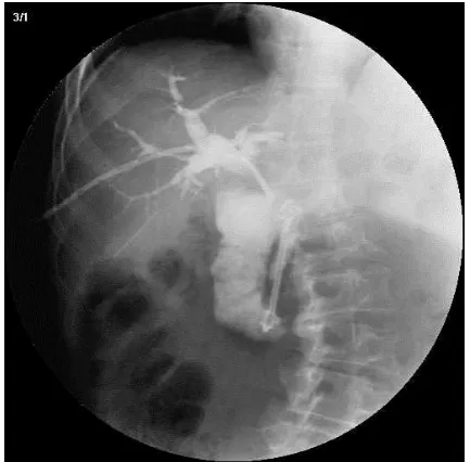 Fig. 7. Plastic “double mushrooms” prosthesis implant-ed percutaneously transhepatically due to common bile duct occlusion