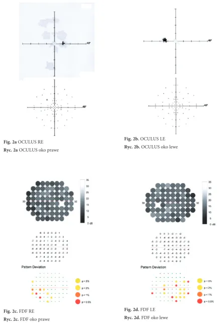 Fig. 2b. OCULUS LE