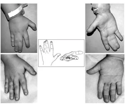 Fig. 5. Chart and clinical example of isolated simple syndactyly release 