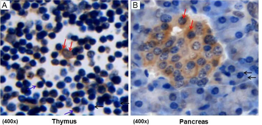 Figure 1. URI/RMP expression in tissues of thymus and pancreas. A. Thymus: Lymphocytes without URI/RMP ex-pression in nuclei and cytoplasms were indicated by black arrows