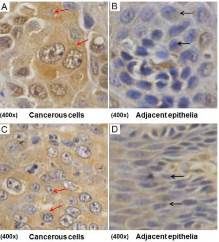 Figure 2. URI/RMP expression in cervical cancer and adjacent tissues. URI/RMP is highly expressed both in nuclei and in cytoplasms of the cervical SCC (squamous cell carcinoma) cells (A, C, red arrows)