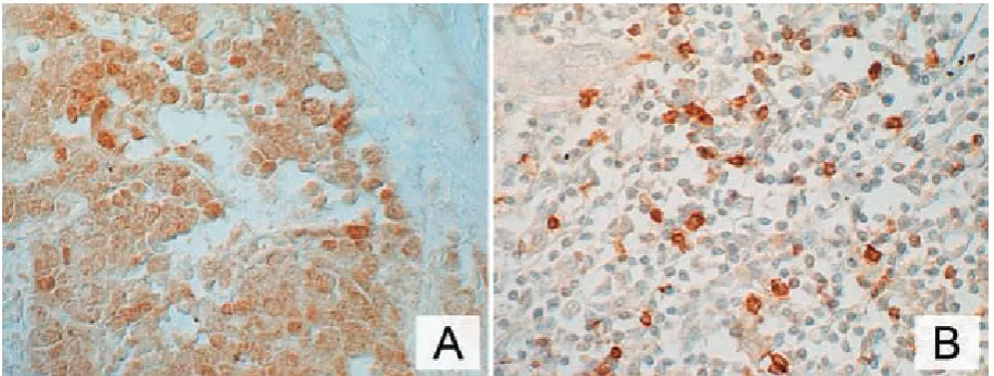 Fig. 5. Comparison of mean values of IL-2α expression in A) tumor cells (g) and B) tumor infiltrating lymphocytes (n) in particular groups of patientsRyc