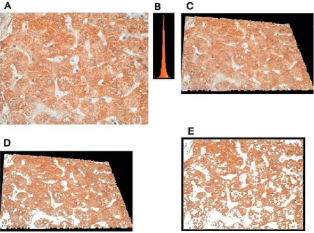 Fig. 1. A4D software screen shot: threshold segmentation of ICC reaction (brown) of IGF-I expression in the liver of a patient with chronic hepatitis C: (A) image obtained using a light microscope (×40 objective) connected to a dig-ital camera, ABC technique; cell nuclei counterstained with hematoxylin, (B) histogram of the colors composing the shades of the brown IGF-I coloring, (C) spatial transformation of a flat microscope image (A), (D) segmentation of IGF-I from a spatial image (C), (E) projection of the spatially transformed reaction onto a plane as a final result of automatic IGF-I segmentation for measuring its area and its share (%) of the area of liver parenchyma