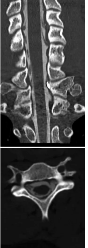 Fig. 2. CT myelography, coronal plane: a – lack of out-line of C6, C7, C8 and T1 nerve roots on the left, small pseudocyst of the T1 root