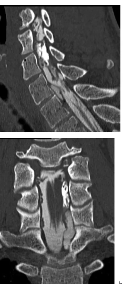 Fig. 6. CT myelography (coronal plane) shows pseu-docysts located inside the spinal canal on C7/T1 and T1/T2 levels and a very small pseudocyst on the C6/C7 level; at the latter level the outline of the root is visible