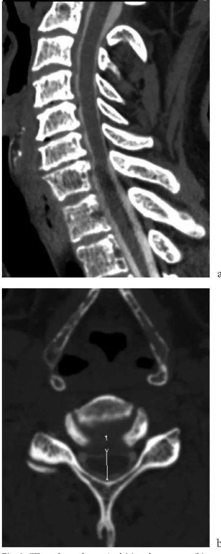 Fig. 7. CT myelography (transverse plane) – a pseudo-cyst visible in the intervertebral foramen on the right, no outline of roots ipsilaterally