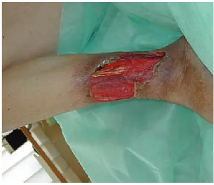 Fig. 1. Critical toe ischemia in essential thrombocythemia