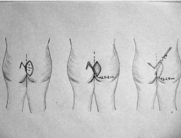 Fig. 3a. Step-by-step asymmetric elliptical excision (1.5–2 cm away from the midline) and closure with Modified Rhomboid Flap (Modified Dofourmentel Technique) 