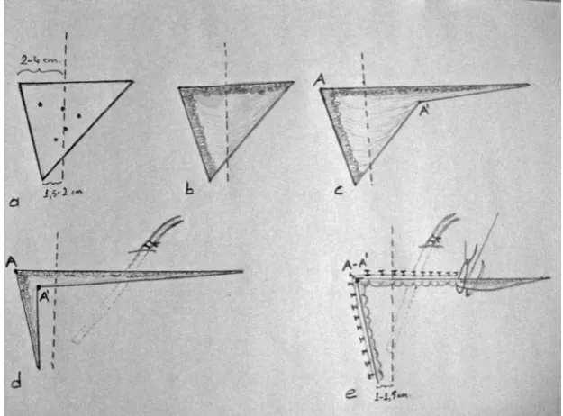Fig. 4a. Scheme of the new tech-nique (triangular excision and closure with rotation advancement flap technique)