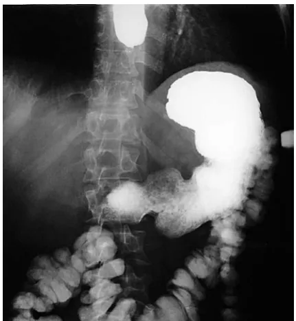 Fig. 5. Left side esophago-pleural fistula (case 4)