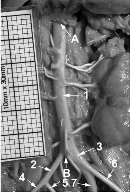 Fig. 1. The abdominal aorta and iliac arteries in a female fetus aged 24 weeks: A) aortic hiatus of the diaphragm, B) aortic bifurcation, 1 – abdominal aorta, 2 – right com-mon iliac artery, 3 – left common iliac artery, 4 – right  external iliac artery, 5 – right internal iliac artery, 6 – left external iliac artery, 7 – left internal iliac artery