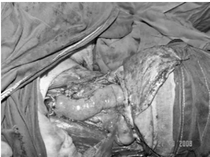 Fig. 1. Transillumination showing arches on the mes-enteric border of the jejunum