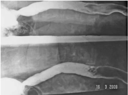 Fig. 3. The monitoring segment can be seen in the lat-eral aspect of the neck. On the fifth post-operative day, the monitoring segment is excised under local anesthe-sia at the bedside