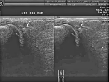 Fig. 1. Image of bone erosion within the joint of the metatarsal-phalangeal third finger of the left foot, longitudinal cross section