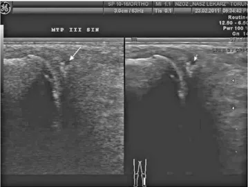 Fig. 3. Image of bone erosion within the joint of the metatarsal-phalangeal third finger of the left foot, longitudinal cross section