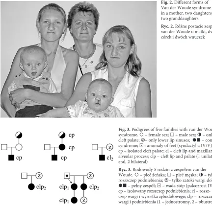 Fig. 1. Complete Van der Woude syndrome: bilateral cleft lip and palate and lower lip sinuses