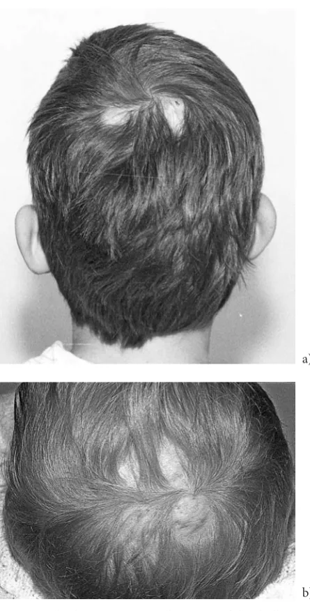 Fig. 1. Multiple ACC types on the vertex of the skull: double (a), quadruple (b)