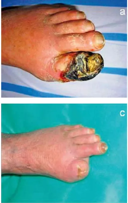 Fig. 4. Limb salvage in patent who underwent intra-muscular gene transfer of naked plasmid encoding VEGF165: (a) before treatment, (b) 6 weeks after gene transfer, (c) 12 weeks after gene transfer