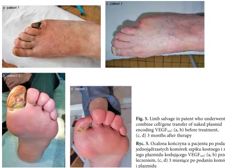 Fig. 5. Limb salvage in patent who underwent combine cell/gene transfer of naked plasmid 