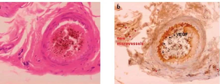 Fig. 6. The presence of VEGF protein and angiogenesis in tissue specimens revealed by histology and immunohis-tochemistry staining: (a) capillary occluded by thrombus, (b) signs of VEGF protein and new microvessels